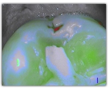 tooth under fluorescent lighting
